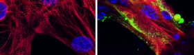 Covid in heart muscle: Microscope images showing (left) healthy heart muscle cells and (right) heart muscle cells that have been infected and damaged by the SARS-CoV-2 virus (in green). Credit: UCLA Broad Stem Cell Research Center/JCI Insight