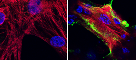 Covid in heart muscle: Microscope images showing (left) healthy heart muscle cells and (right) heart muscle cells that have been infected and damaged by the SARS-CoV-2 virus (in green). Credit: UCLA Broad Stem Cell Research Center/JCI Insight