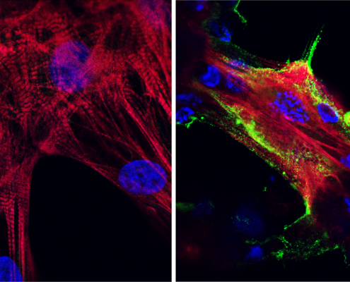 Covid in heart muscle: Microscope images showing (left) healthy heart muscle cells and (right) heart muscle cells that have been infected and damaged by the SARS-CoV-2 virus (in green). Credit: UCLA Broad Stem Cell Research Center/JCI Insight