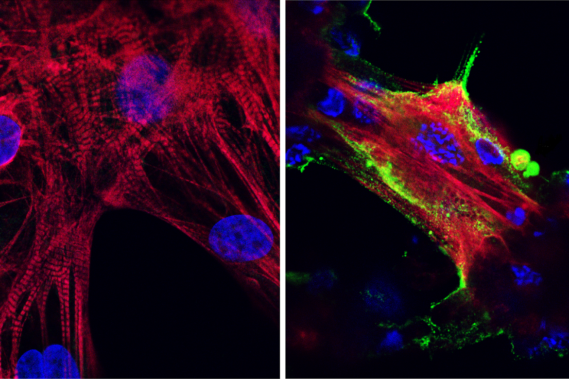 Covid in heart muscle: Microscope images showing (left) healthy heart muscle cells and (right) heart muscle cells that have been infected and damaged by the SARS-CoV-2 virus (in green). Credit: UCLA Broad Stem Cell Research Center/JCI Insight