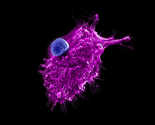 Image of an engineered HSC-iNKT cell (blue) attacking a human tumor cell. Photo Credit: Yang Lab/UCLA