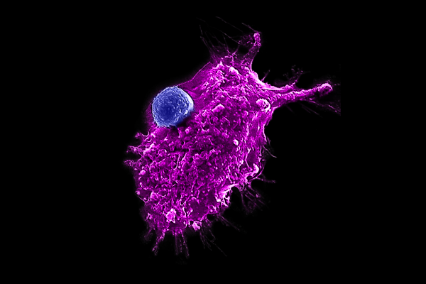 Image of an engineered HSC-iNKT cell (blue) attacking a human tumor cell. Photo Credit: Yang Lab/UCLA