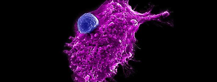 Image of an engineered HSC-iNKT cell (blue) attacking a human tumor cell. Photo Credit: Yang Lab/UCLA