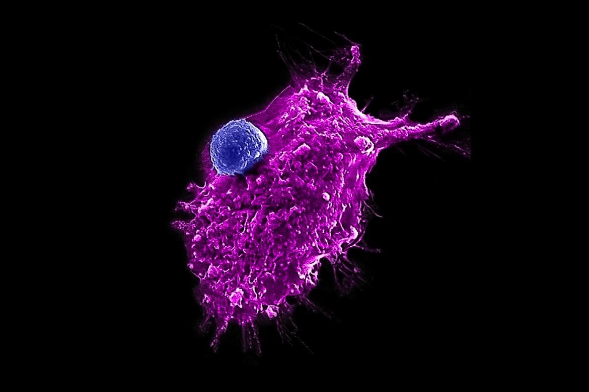 Image of an engineered HSC-iNKT cell (blue) attacking a human tumor cell. Photo Credit: Yang Lab/UCLA