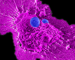 Microscopy-363-241 CAR NKT cells attacking ovarian cancer cells.