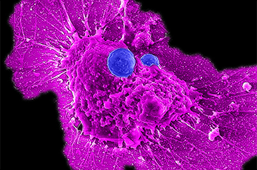CAR NKT cells attacking ovarian cancer cells.