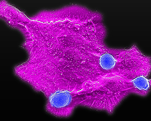 Microscopy image showing blood stem cell-engineered CAR-NKT cells (three blue dots) attacking a human solid tumor cell (magenta)