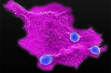 Microscopy image showing blood stem cell-engineered CAR-NKT cells (three blue dots) attacking a human solid tumor cell (magenta)